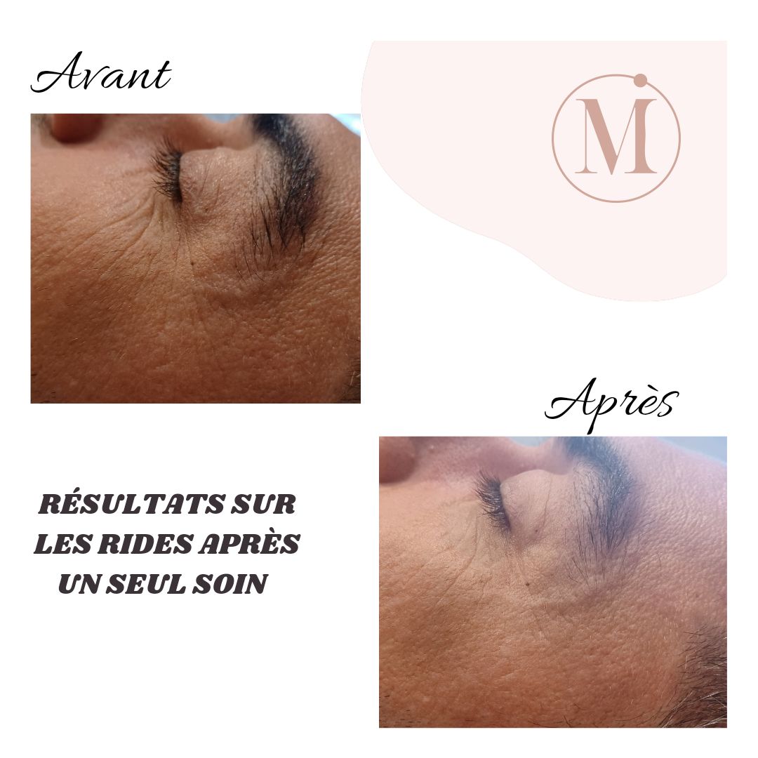 Résultat avant/après soin dermo-esthétique - Peau régénérée et revitalisée